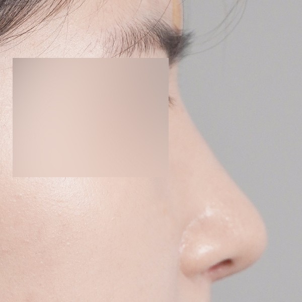 코끝,비중격,귀연골,매부리,복코,절골,비순각