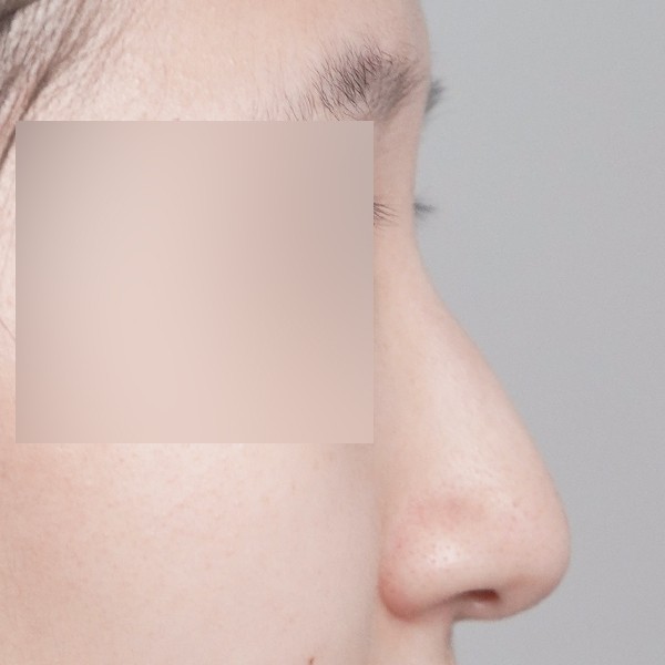 코끝,비중격,귀연골,매부리,복코,비순각