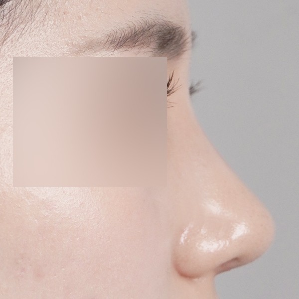 코끝,비중격,귀연골,매부리,복코,절골,비순각