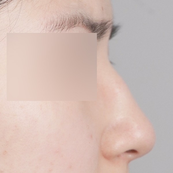 코끝,비중격,귀연골,매부리,복코,절골,비순각